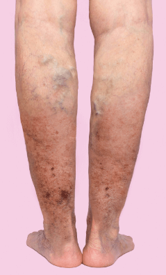 Varices