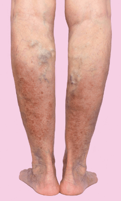 Varices