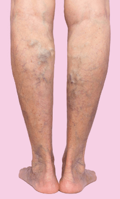 Varices