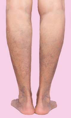 Varices